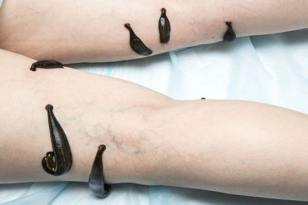 Leech Therapy